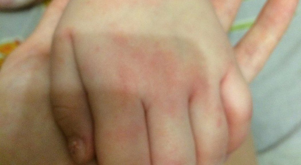 В Перми игрушка-подарок вызвала сильную аллергию у ребенка